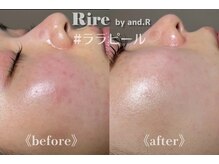 リル バイ アンドアール(Rire by and.R)/ララピール（施術1回）