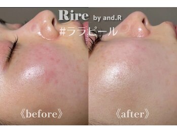 リル バイ アンドアール(Rire by and.R)/ララピール（施術1回）