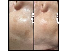 ココスタイルビューティー(COCOSTYLE beauty)の雰囲気（スノーピール使用前→使用後はシミがかなり軽減！）