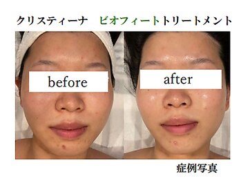 マーガレット(Marguerite)/CHRISTINAビオフィート症例