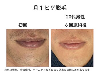 ダーウィン(Darwin)/毎日の髭剃りから解放!