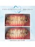 【新生活応援学割U24】デイリーケアセルフホワイトニング（20分×２セット）