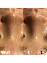 エステサロン マコ(MaCo)/30代・頑固な毛穴の黒ずみに