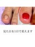 【foot深爪矯正＋即日綺麗】美しい見た目に！足の爪が短い方に16000→15000