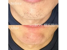 気になる髭も美容電気脱毛でスッキリ！デザイ髭・白髪髭も可能！