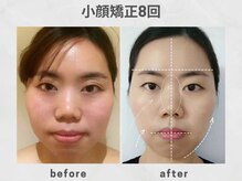 ビトリア 横浜店(BITORIA)の雰囲気（顔の大きさ、フェイスライン、左右差、むくみなど改善 ）