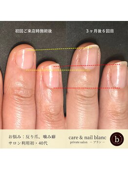 ブラン(blanc)/自爪育成３ケ月集中ケアコース