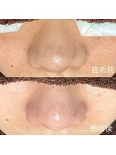 エクラ バイ シャンリィ(eclat by shanLy)/黒ずみ解消