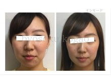 メディカルエステ 大宮店/＊高周波症例写真＊
