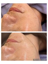 ルピナージュ(Lupinage)/小顔フェイシャル