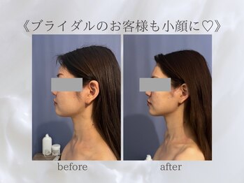 ジュプン 長崎/小顔筋膜のお客様！