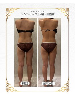 レイ(Ray)/ブライダルエステ