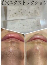 アンベール(unveil)/毛穴ケア