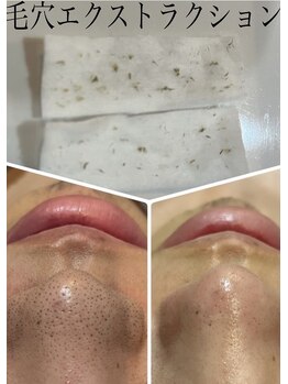 アンベール(unveil)/毛穴ケア