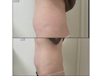 エクリル(Eclire)/下腹ポッコリ/厚み