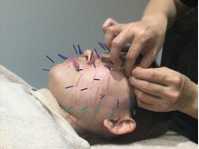 高田馬場名倉堂鍼灸接骨院/美容鍼