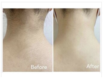 エアリアル 八代店/手の届かないうなじの毛