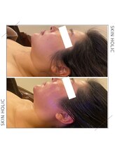 スキンホリック 恵比寿駅前店(SKIN HOLIC)/フェイスラインもスッキリ！