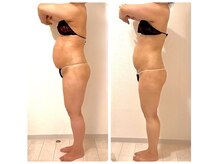 インディバや脂肪冷却やハイパーナイフ超えの圧倒的効果で痩身！