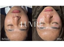 ルーヴレ(LUVRE)/フェイシャルWAX