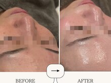 ハイフン(HIFUN)/ララピール毛穴洗浄