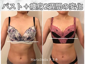 マリスステラ 天王寺(MarisStella)/バスト＆痩身2週間の変化