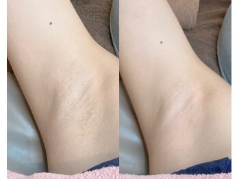 リリー(Lily)/【WAX脱毛】