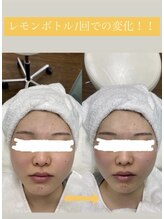 エステサロン ソワン/レモンボトルの効果