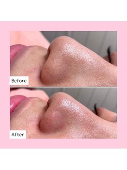 ホワイトラボ 岸和田店(White labo)/【施術例】ハイドロ毛穴洗浄