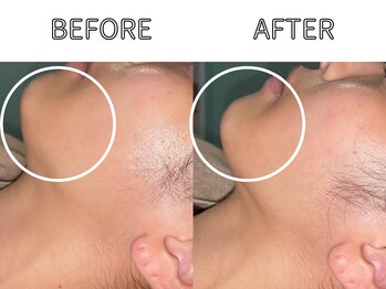 ライム 天神(LIME)/症例写真｜お肌の赤みケア