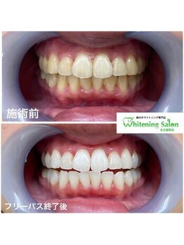 ホワイトニングサロン 名古屋駅店/【ホワイトニング施術例】