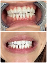 ビューティーケア(beauty care)/【ホワイトニング】