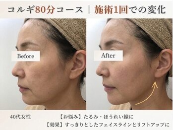 ポラリス(Polaris)の写真/【最強引き上げ】小顔コルギ+切らないリフトUP+石膏パック 80分 12200円→12900円◆施術1回でも効果実感！
