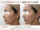 ポラリス(Polaris)の写真/【最強引き上げ】小顔コルギ+切らないリフトUP+石膏パック 80分 12200円→12900円◆施術1回でも効果実感！