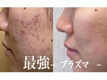 美的アヴェニール(美的.Avenir)の雰囲気（【水素×美容】水素洗浄×プラズマ《アクネ菌除去》保湿仕上げ）