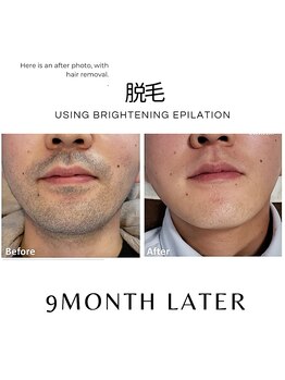 ハグミー 甲子園口(HUGME.)/脱毛のみでツヤ肌まで&若帰り★