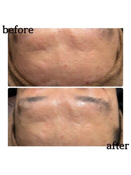 エタビー(etebe)/毛穴ビフォーアフター