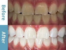 アース 岡崎店(EARTH)/【ビフォーアフター】美白