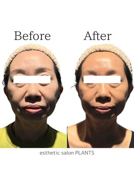 プランツ(PLANTS)/50代／１回／ほうれい線