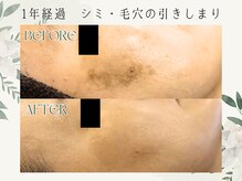 ラフラフ(Laf Laf)/シミ改善