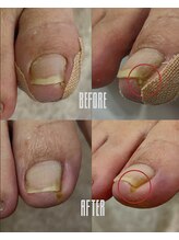 おん/親指の角が痛い！