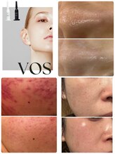 エルール トータルビューティ(Aileure total beauty)/最先端のVOSハーブピーリング