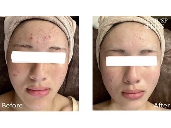 フーラ バイ アングラーズ(fu-ra by ANGLERS)/【光フェイシャル】毛穴ケア