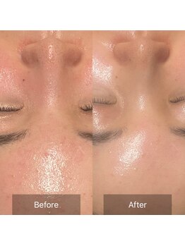 サロンツキ(salon tuki)/【ハーブピーリング】施術1回★