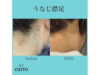 アクト クロ(ACT curro)/【うなじ襟足】脱毛施術例