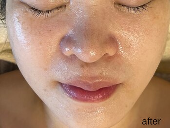 サロン ド エメ(salon de aimer)/【After】毛穴キュ!潤いアップ
