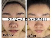 マスカレード(Masquerade)/【ララピール症例写真】