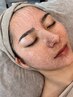【水光肌×35歳からのエイジングケア】剥離なし◎最新LHAロゼピーリング