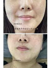 メディカルサロンドオフ 堺東店(medical salon de off)/LEZE(ルゼ)カクテルピーリング