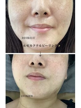 メディカルサロンドオフ 堺東店(medical salon de off)/LEZE(ルゼ)カクテルピーリング